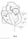 Fig. 05 - Trans-apical implant systems, implants and methods