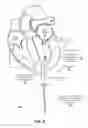 Fig. 09 - Trans-apical implant systems, implants and methods
