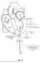 Fig. 10 - Trans-apical implant systems, implants and methods