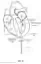 Fig. 11 - Trans-apical implant systems, implants and methods