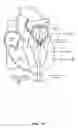 Fig. 14 - Trans-apical implant systems, implants and methods