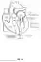 Fig. 15 - Trans-apical implant systems, implants and methods