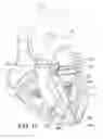 Fig. 07 - Method for treating a mitral valve