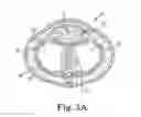 Fig. 04 - Penile prosthetic insert with a body having a channel and a method for implantation of a penile prosthetic