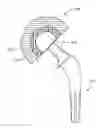 Fig. 01 - REVISION HIP IMPLANTS AND PROSTHESIS SYSTEMS