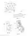 Fig. 06 - REVISION HIP IMPLANTS AND PROSTHESIS SYSTEMS