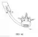 Fig. 17 - Expandable interbody fusion device