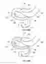 Fig. 50 - Delivery devices and methods for gastrointestinal implants