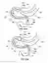 Fig. 52 - Delivery devices and methods for gastrointestinal implants