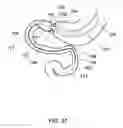 Fig. 53 - Delivery devices and methods for gastrointestinal implants