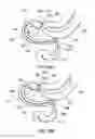 Fig. 58 - Delivery devices and methods for gastrointestinal implants