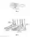 Fig. 04 - Ankle support