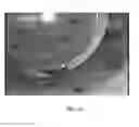 Fig. 16 - Method for Alignment of Intraocular Lens