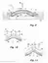 Fig. 14 - Absorbent article demonstrating controlled deformation and longitudinal fluid distribution