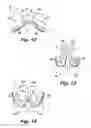 Fig. 15 - Absorbent article demonstrating controlled deformation and longitudinal fluid distribution