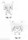 Fig. 17 - Absorbent article demonstrating controlled deformation and longitudinal fluid distribution