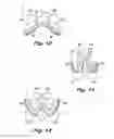Fig. 15 - ABSORBENT ARTICLE DEMONSTRATING CONTROLLED DEFORMATION AND LONGITUDINAL FLUID DISTRIBUTION