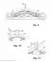 Fig. 14 - Absorbent article demonstrating controlled deformation and longitudinal fluid distribution