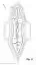 Fig. 10 - Absorbent article demonstrating controlled deformation and longitudinal fluid distribution