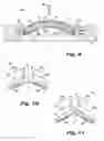 Fig. 14 - Absorbent article demonstrating controlled deformation and longitudinal fluid distribution