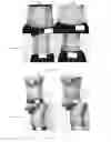 Fig. 15 - METHOD OF TREATMENT FOR BODY CONTOURING
