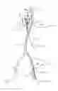 Fig. 10 - Catheter-based heart support system and method of implanting thereof