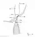 Fig. 15 - Catheter-based heart support system and method of implanting thereof