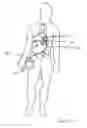 Fig. 16 - Catheter-based heart support system and method of implanting thereof