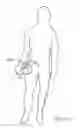 Fig. 17 - Catheter-based heart support system and method of implanting thereof