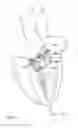 Fig. 21 - Catheter-based heart support system and method of implanting thereof