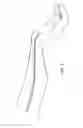 Fig. 05 - Method and device for sheathless arterial catheterization