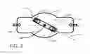 Fig. 03 - Optoelectronic sensing of a subcutaneous implant setting