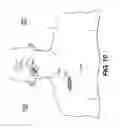 Fig. 09 - Obstructive sleep apnea treatment devices, systems and methods