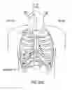 Fig. 104 - Obstructive sleep apnea treatment devices, systems and methods