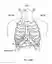 Fig. 106 - Obstructive sleep apnea treatment devices, systems and methods