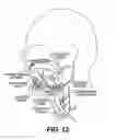 Fig. 11 - Obstructive sleep apnea treatment devices, systems and methods