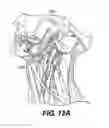 Fig. 12 - Obstructive sleep apnea treatment devices, systems and methods