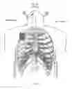 Fig. 129 - Obstructive sleep apnea treatment devices, systems and methods