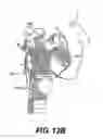 Fig. 13 - Obstructive sleep apnea treatment devices, systems and methods