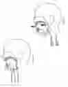 Fig. 138 - Obstructive sleep apnea treatment devices, systems and methods