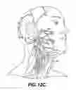 Fig. 14 - Obstructive sleep apnea treatment devices, systems and methods