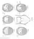 Fig. 146 - Obstructive sleep apnea treatment devices, systems and methods