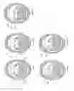 Fig. 147 - Obstructive sleep apnea treatment devices, systems and methods