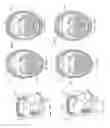 Fig. 155 - Obstructive sleep apnea treatment devices, systems and methods