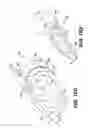 Fig. 18 - Obstructive sleep apnea treatment devices, systems and methods