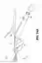 Fig. 28 - Obstructive sleep apnea treatment devices, systems and methods