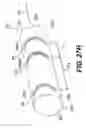 Fig. 37 - Obstructive sleep apnea treatment devices, systems and methods