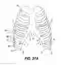 Fig. 51 - Obstructive sleep apnea treatment devices, systems and methods