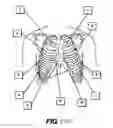 Fig. 53 - Obstructive sleep apnea treatment devices, systems and methods
