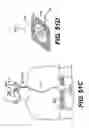 Fig. 71 - Obstructive sleep apnea treatment devices, systems and methods